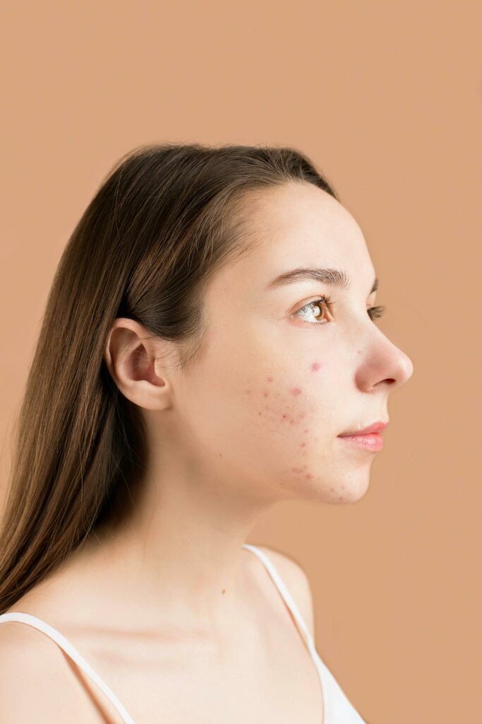 A woman with Acne Unmasked