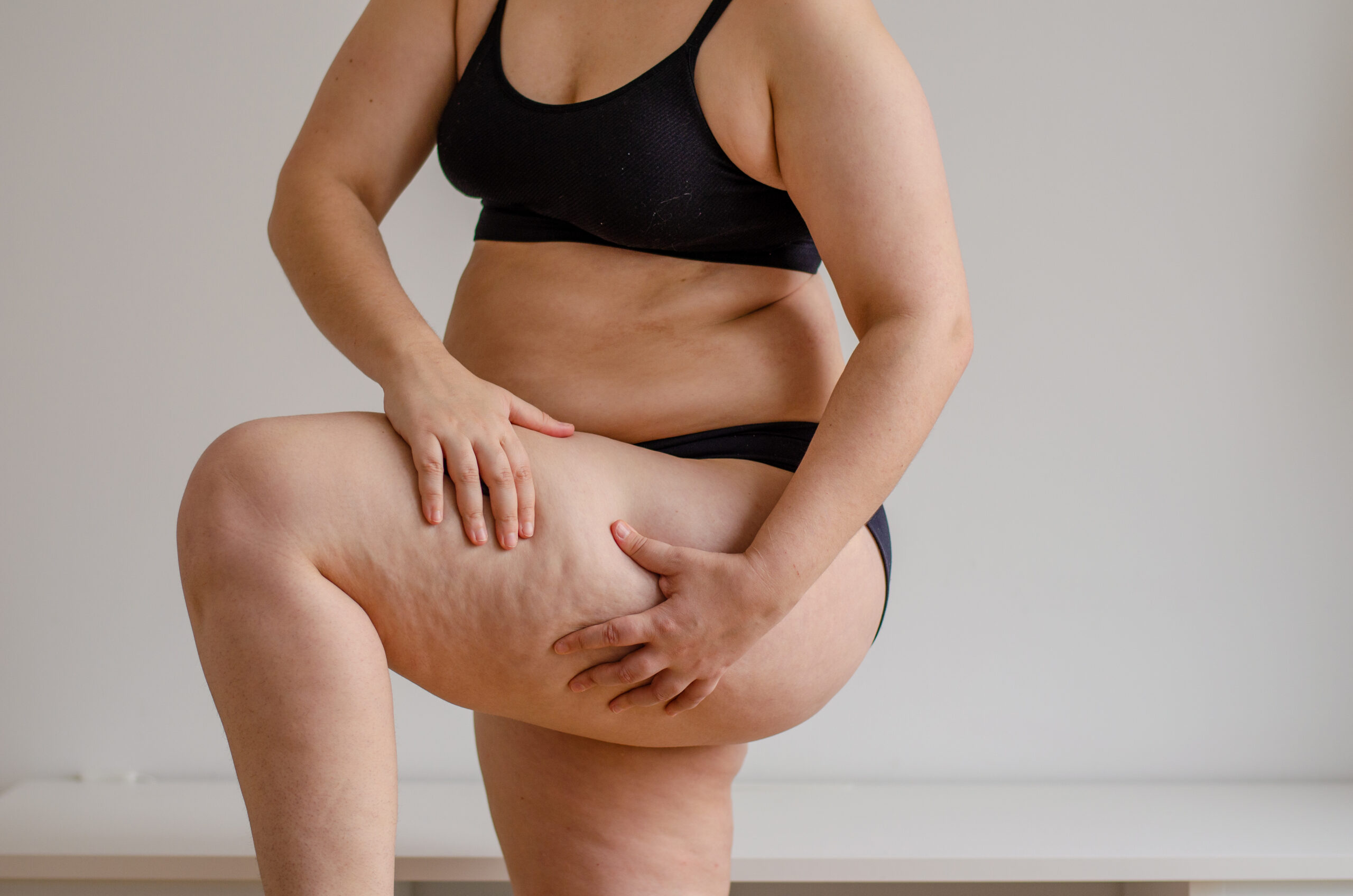 Morpheus8 Body Breakthrough in Cellulite Reduction